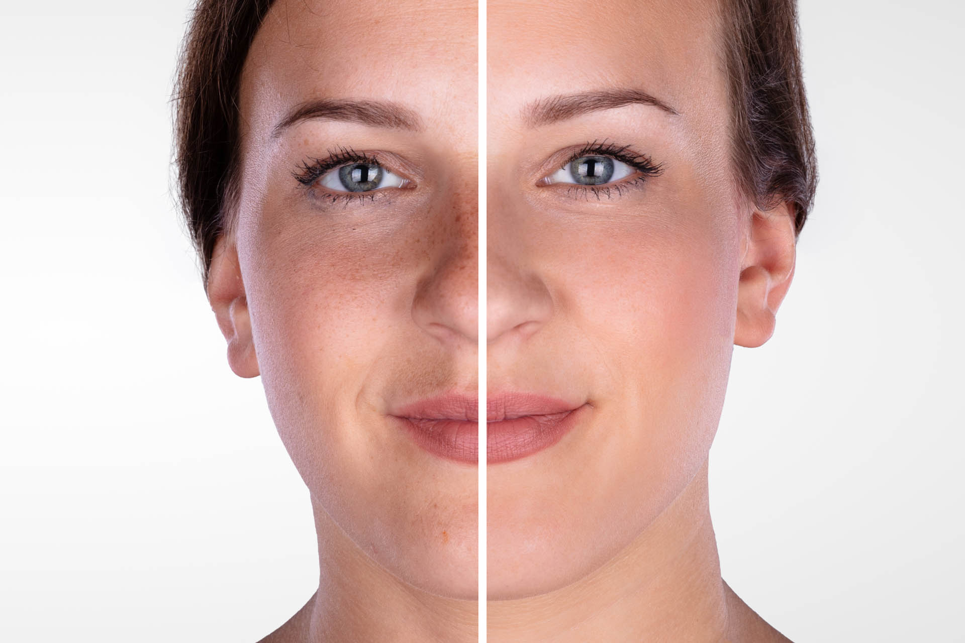 Close-up Of A Young Woman's Face Before And After Cosmetic Procedure